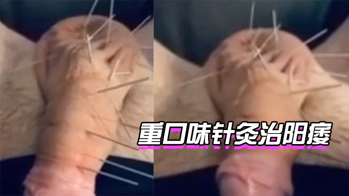 针灸治阳痿，你想试下吗 海报
